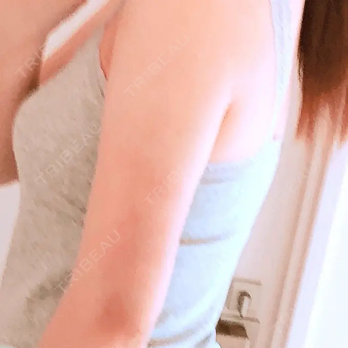 脂肪吸引（二の腕） 湘南メディカル記念病院（両国） DAY 65 メイン用