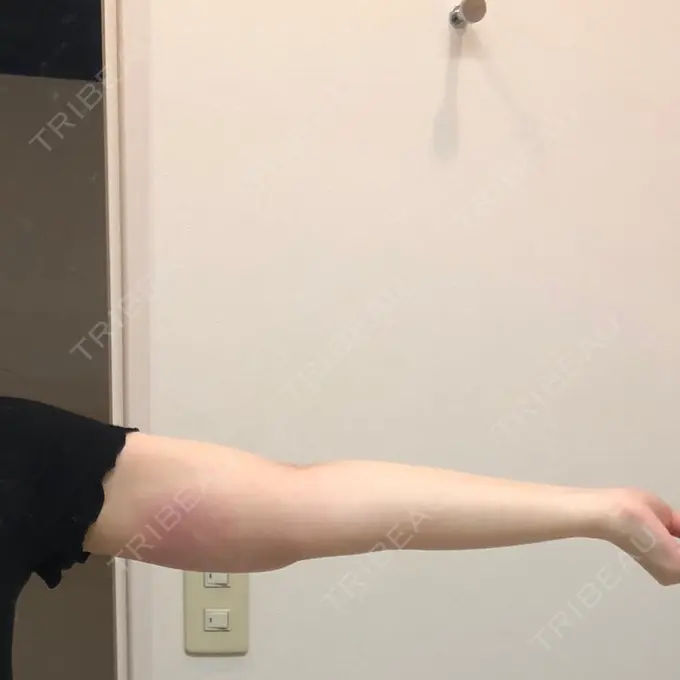 脂肪吸引（二の腕） 湘南メディカル記念病院（両国） DAY 39 メイン用