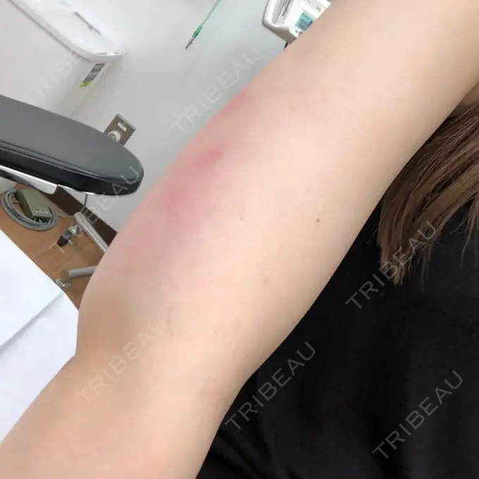 脂肪吸引（二の腕） 湘南メディカル記念病院（両国） DAY 39 メイン用