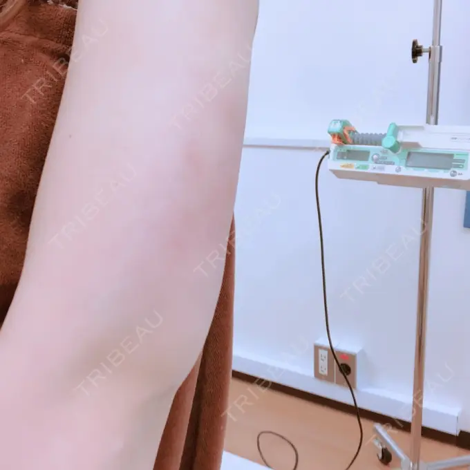 脂肪吸引（二の腕） 湘南メディカル記念病院（両国） DAY 50 メイン用