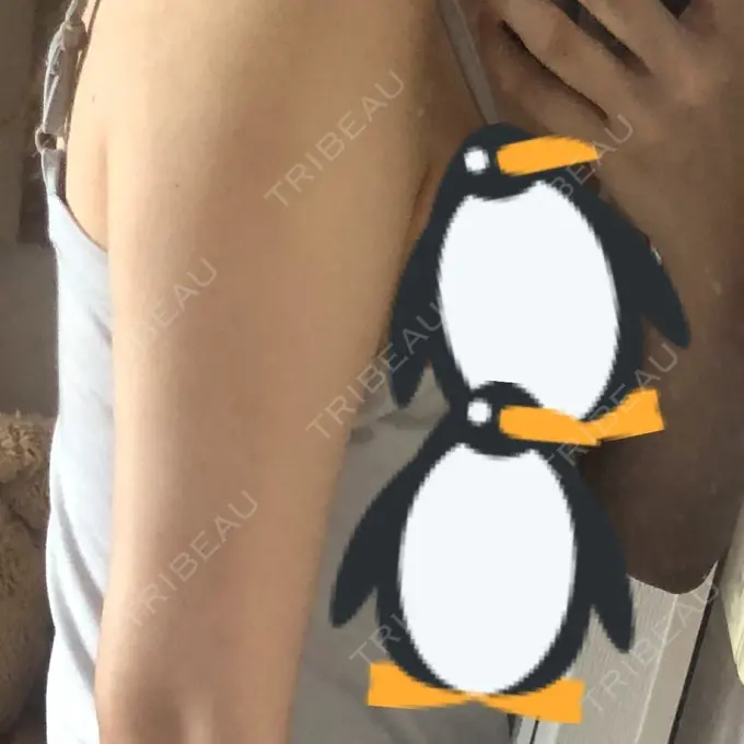 脂肪吸引（二の腕） 湘南メディカル記念病院（両国） DAY 90 メイン用