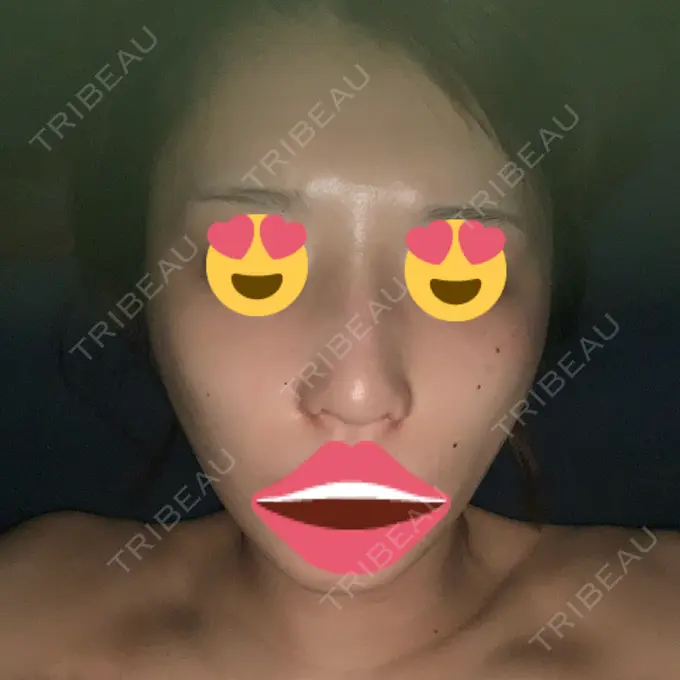 隆鼻術 / 鼻尖形成（切開） / 小鼻縮小（切開） / ボトックス（エラ・小顔） / その他（鼻） ルラ美容クリニック 高田馬場院 DAY 10 メイン用