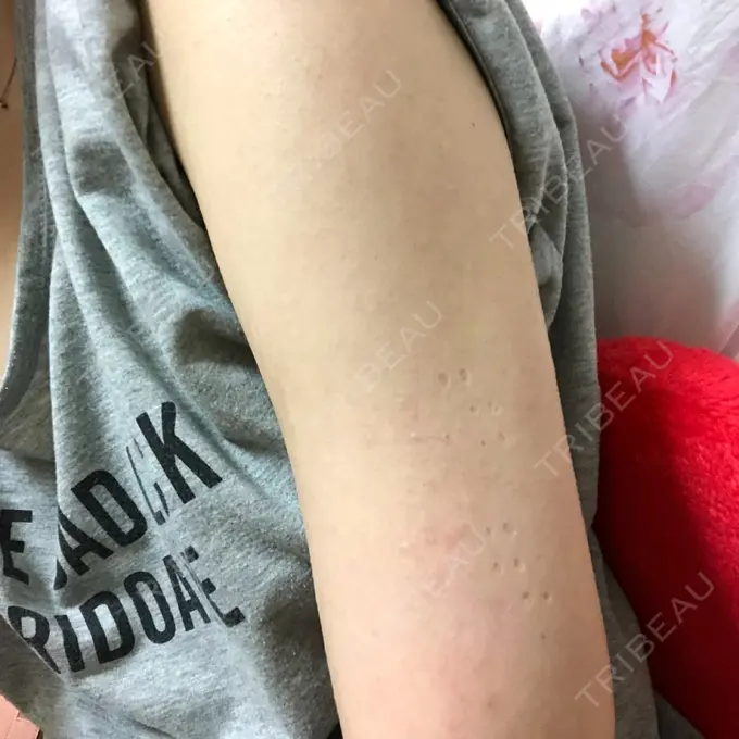 脂肪吸引（二の腕） 湘南メディカル記念病院（両国） DAY 35 メイン用