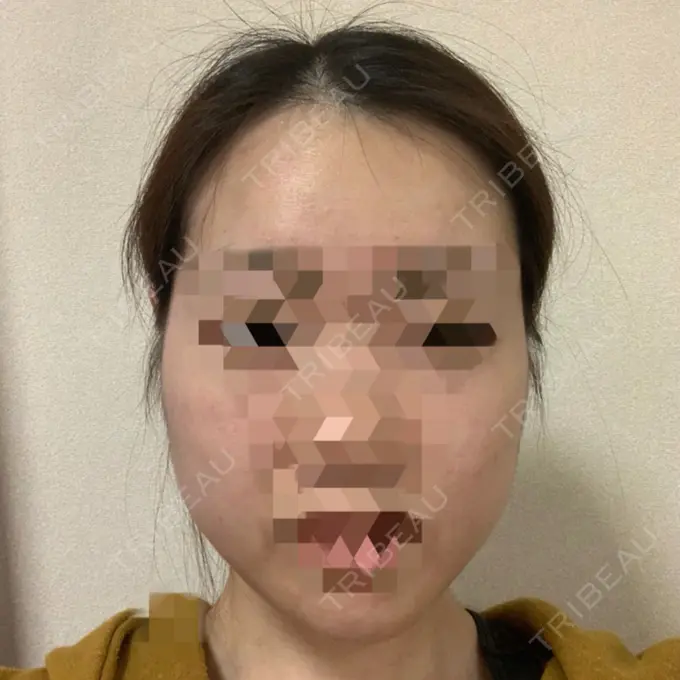 糸リフト / 骨切り（あご） / 骨削り（エラ） RG整形外科（旧リオン整形外科） DAY 30 メイン用