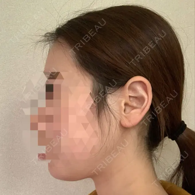 糸リフト / 骨切り（あご） / 骨削り（エラ） RG整形外科（旧リオン整形外科） DAY 30 メイン用