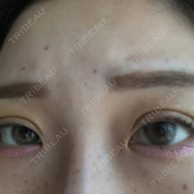 二重切開 品川スキンクリニック広島院 AFTER メイン用