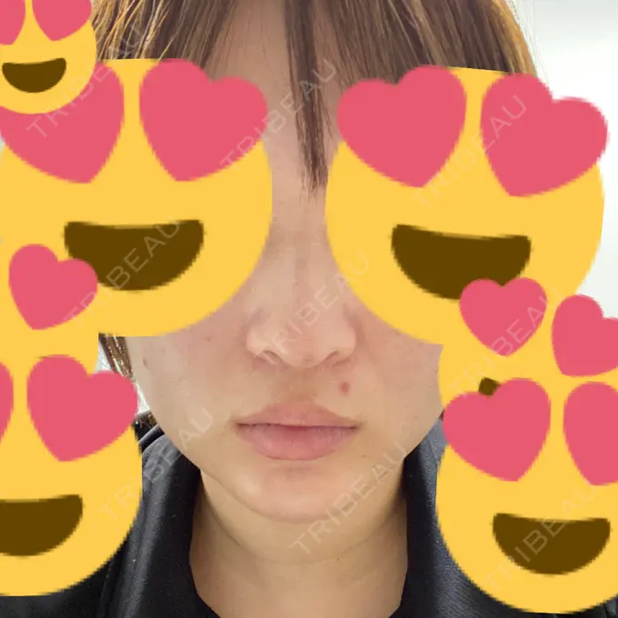 鼻中隔延長（切開） / ヒアルロン酸注入（あご） あいちビューティークリニック栄本院 DAY 9 メイン用