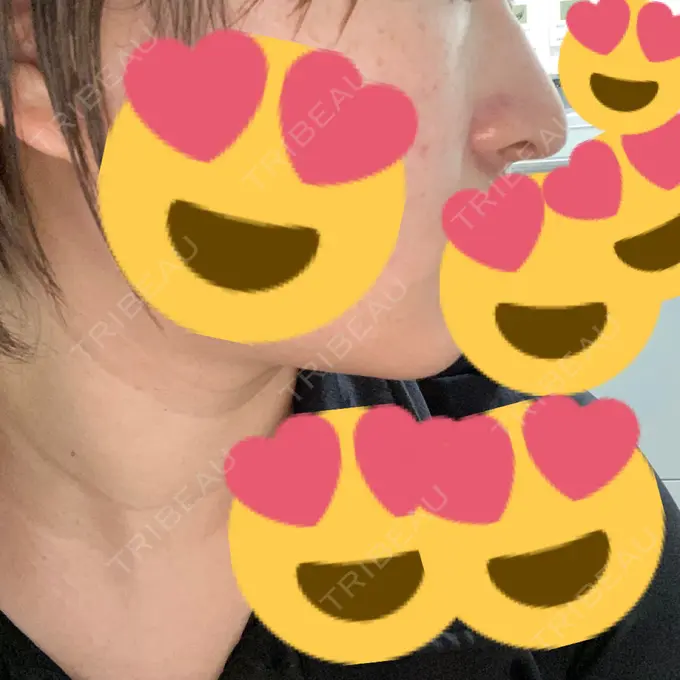 鼻中隔延長（切開） / ヒアルロン酸注入（あご） あいちビューティークリニック栄本院 DAY 9 メイン用