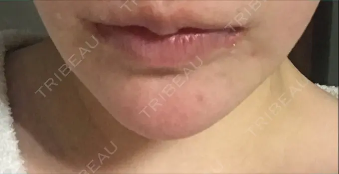 口角挙上 現代美学整形外科 DAY 49 メイン用