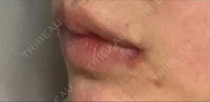 口角挙上 現代美学整形外科 DAY 49 メイン用