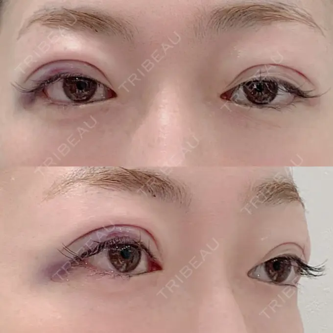 二重埋没 / 眼瞼下垂（切開） BIANCA表参道 DAY 0 メイン用