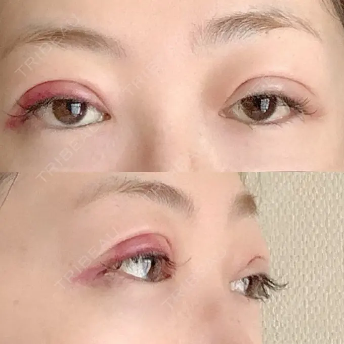 二重埋没 / 眼瞼下垂（切開） BIANCA表参道 DAY 1 メイン用