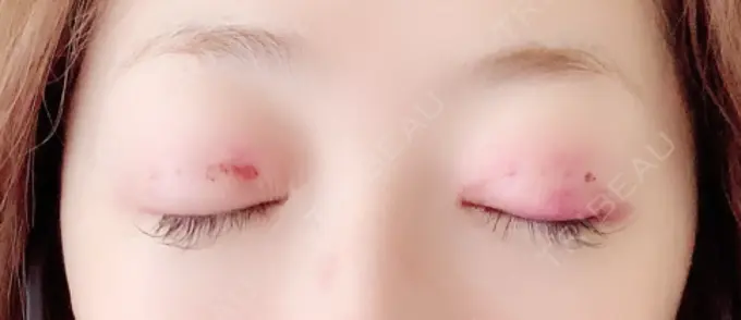 二重埋没 / 眼瞼下垂（切開） BIANCA表参道 DAY 1 メイン用