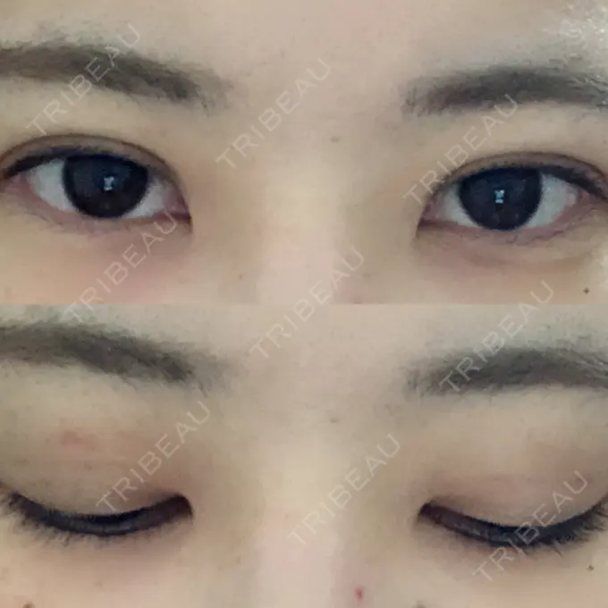 二重埋没 / 上まぶたの脂肪取り 湘南美容クリニック 柏院 AFTER メイン用