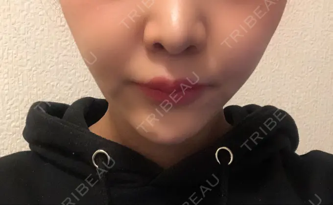人中短縮 新宿ラクル美容外科クリニック 新宿院 AFTER メイン用