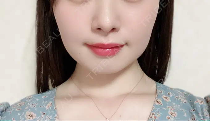 脂肪溶解注射（顔） 赤坂プレミアクリニック DAY 0 メイン用