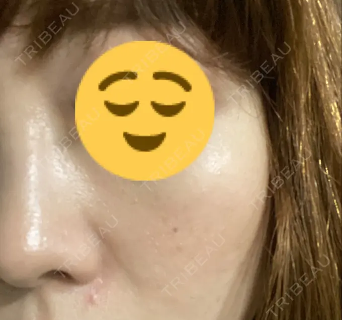 イオン導入 / 美肌レーザー / シミ取りレーザー / エレクトロポレーション 湘南美容クリニック 秋葉原院 DAY 48 メイン用