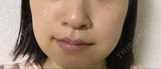 脂肪吸引（顔） 湘南美容クリニック 京都院 DAY 9 メイン用