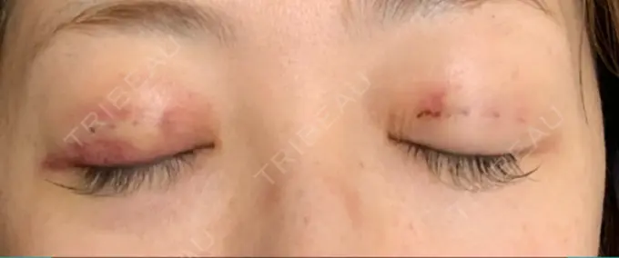 二重埋没 / 眼瞼下垂（切開） BIANCA表参道 DAY 2 メイン用