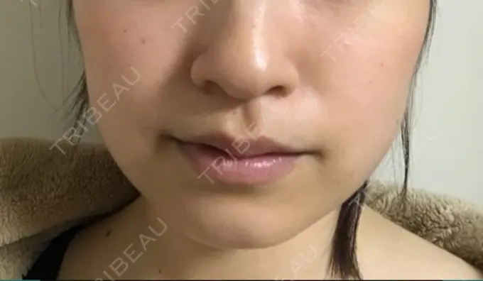 脂肪吸引（顔） 湘南美容クリニック 京都院 DAY 28 メイン用