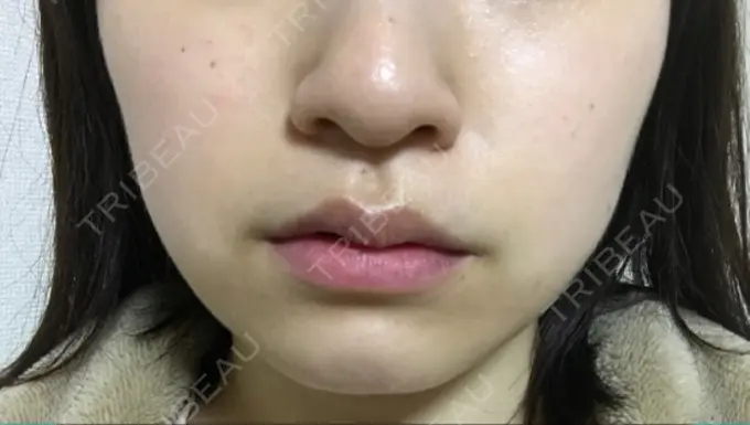 脂肪吸引（顔） 湘南美容クリニック 京都院 DAY 59 メイン用