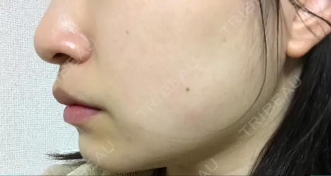 脂肪吸引（顔） 湘南美容クリニック 京都院 DAY 59 メイン用