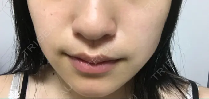 脂肪吸引（顔） 湘南美容クリニック 京都院 AFTER メイン用