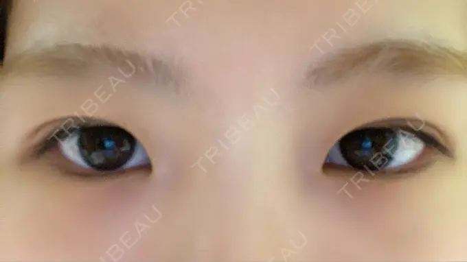 二重切開 きくな湯田眼科 AFTER メイン用