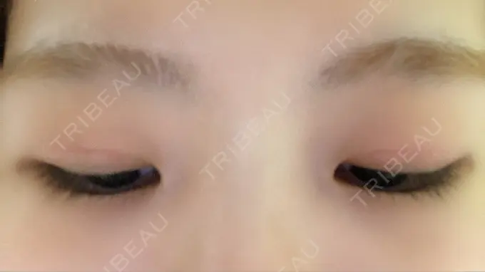 二重切開 きくな湯田眼科 DAY 61 メイン用