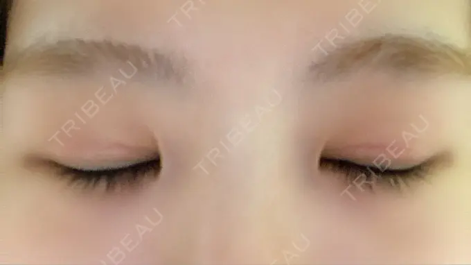 二重切開 きくな湯田眼科 DAY 61 メイン用