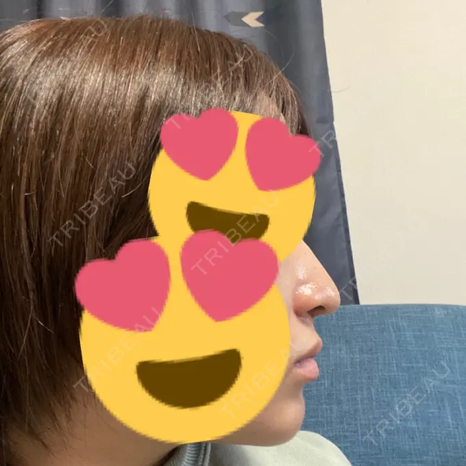 鼻中隔延長（切開） / ヒアルロン酸注入（あご） あいちビューティークリニック栄本院 AFTER メイン用