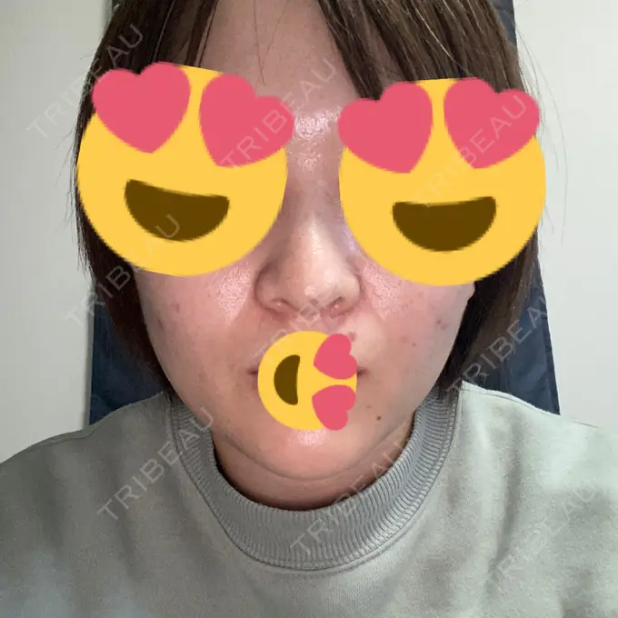 鼻中隔延長（切開） / ヒアルロン酸注入（あご） あいちビューティークリニック栄本院 DAY 11 メイン用