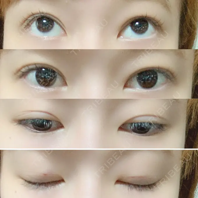 二重埋没 共立美容外科 柏院 DAY 0 メイン用