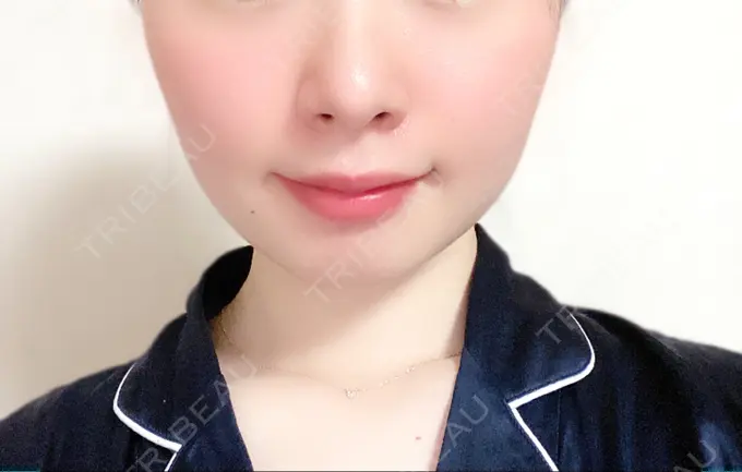 脂肪溶解注射（顔） 赤坂プレミアクリニック DAY 2 メイン用