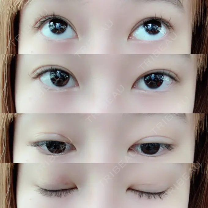 二重埋没 共立美容外科 柏院 DAY 1 メイン用