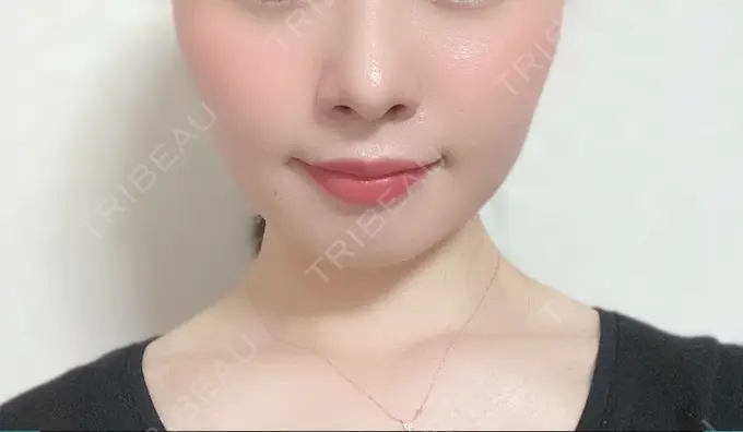 脂肪溶解注射（顔） 赤坂プレミアクリニック DAY 4 メイン用