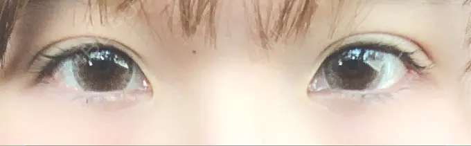 二重埋没 湘南美容クリニック 札幌院 DAY 20 メイン用