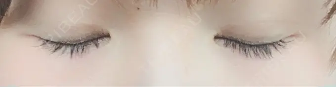 二重埋没 湘南美容クリニック 札幌院 DAY 20 メイン用