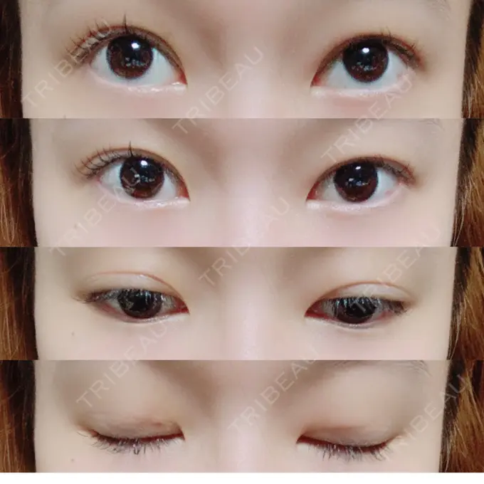 二重埋没 共立美容外科 柏院 DAY 2 メイン用