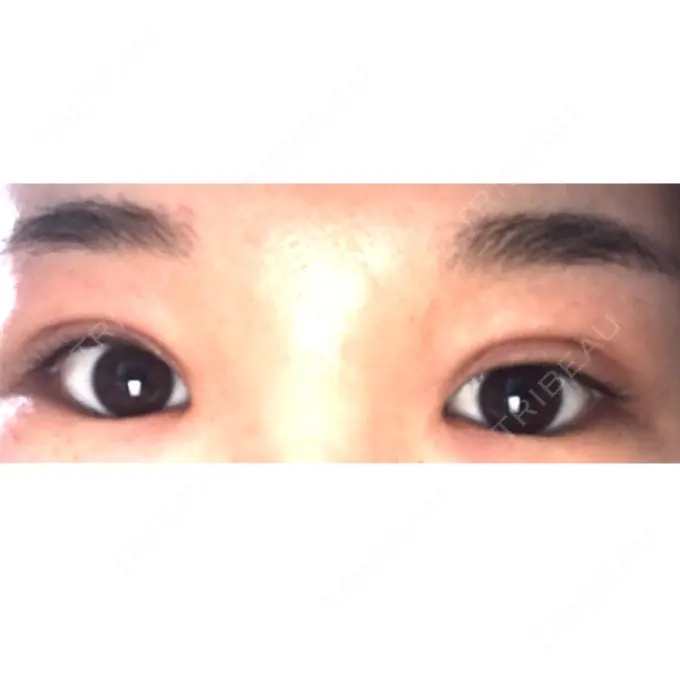 二重切開 / 上まぶたの脂肪取り 品川スキンクリニック広島院 DAY 15 メイン用