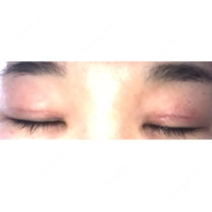 二重切開 / 上まぶたの脂肪取り 品川スキンクリニック広島院 DAY 15 メイン用