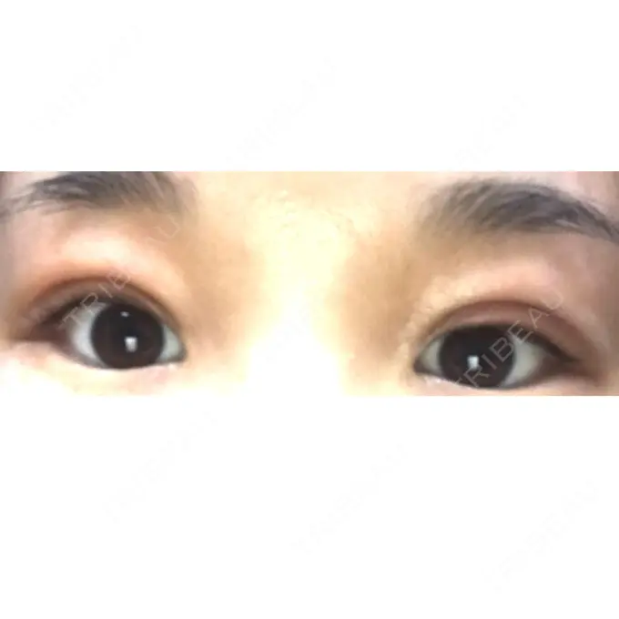 二重切開 / 上まぶたの脂肪取り 品川スキンクリニック広島院 DAY 14 メイン用