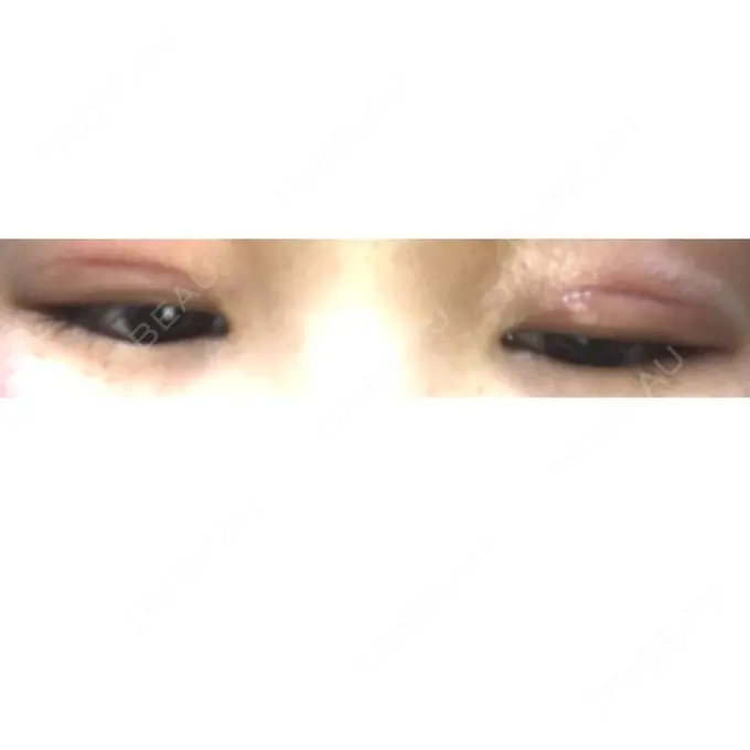 二重切開 / 上まぶたの脂肪取り 品川スキンクリニック広島院 DAY 14 メイン用