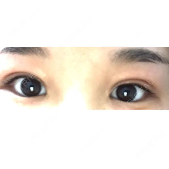 二重切開 / 上まぶたの脂肪取り 品川スキンクリニック広島院 DAY 15 メイン用