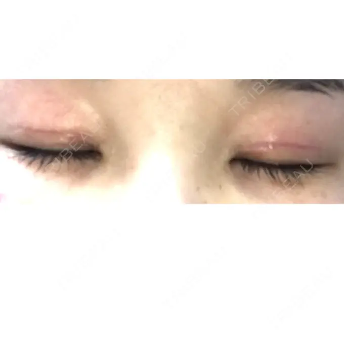 二重切開 / 上まぶたの脂肪取り 品川スキンクリニック広島院 DAY 15 メイン用