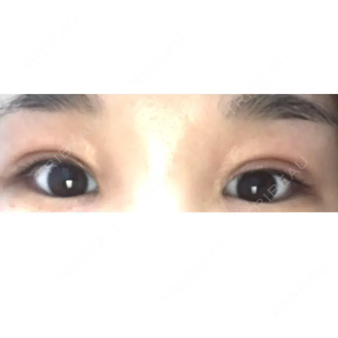 二重切開 / 上まぶたの脂肪取り 品川スキンクリニック広島院 DAY 17 メイン用