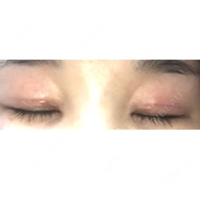 二重切開 / 上まぶたの脂肪取り 品川スキンクリニック広島院 DAY 17 メイン用