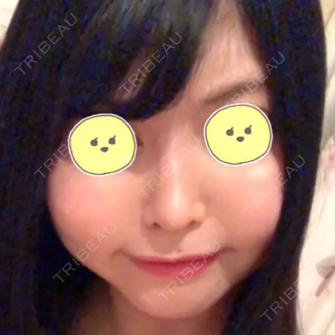 隆鼻術 / 軟骨移植 みずほクリニック AFTER メイン用