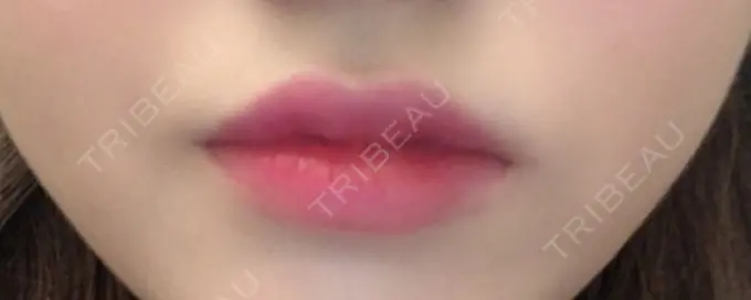 ヒアルロン酸注入（唇） / ボトックス（口角） TCB東京中央美容外科 堺院 DAY 0 メイン用