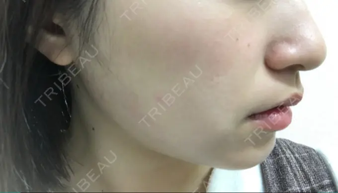 脂肪吸引（顔） 湘南美容クリニック 京都院 DAY 242 メイン用